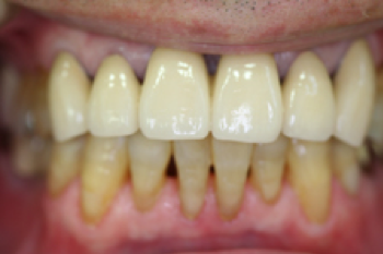 重度歯周病の治療例3_治療後