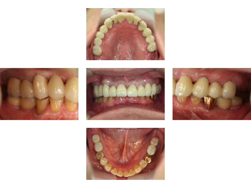 重度歯周病の治療例1_治療後